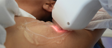 Laser Hair Removal