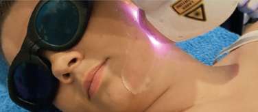 Skin Rejuvenation